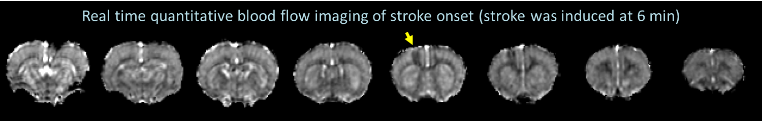 research_StrokeCBF